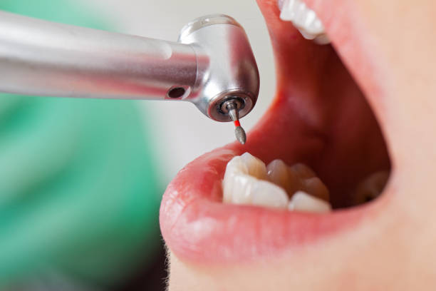 Best Emergency Dentist for Lost Fillings or Crowns in Andrews, NC